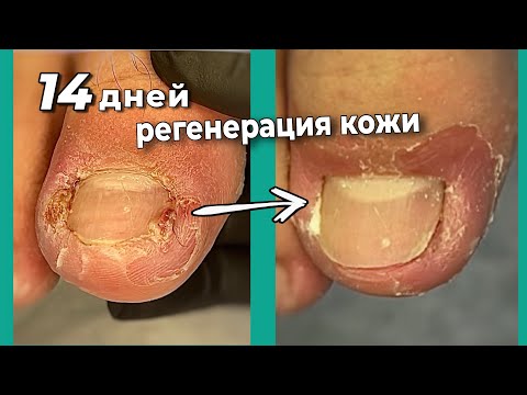 Видео: Секрет в экстренном снятии воспаления и отека кожи