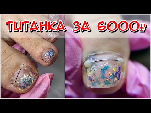 Видео: Титанка за 6000! Почему синяк под ногтем? Покрытие на ногти / Гель лак на ногти на ногах