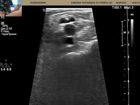 Видео: УЗИ вен ног. Есть ли тромб? Почему есть  отек?