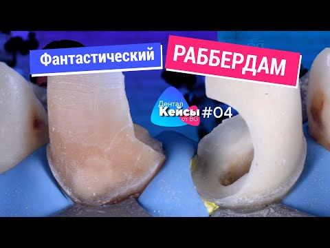 Видео: Раббердам, препарирование и эндодонтия на грани фантастики. Дентал Кейсы от BG. #04