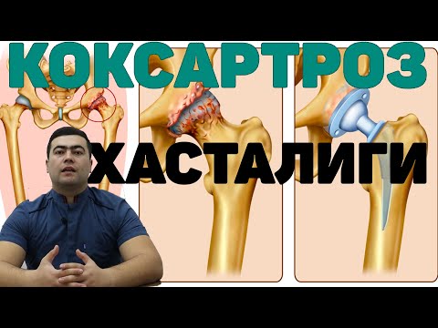 Видео: КОКСАРТРОЗ ХАСТАЛИГИ КЕЛИБ ЧИКИШ САБАБЛАРИ ДАВО ЧОРАЛАРИ | KO`KSARTROZ XASTALIGI HAQIDA BATAFSIL