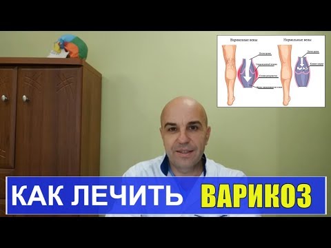 Видео: Как лечить варикоз в домашних условиях #варикоз#