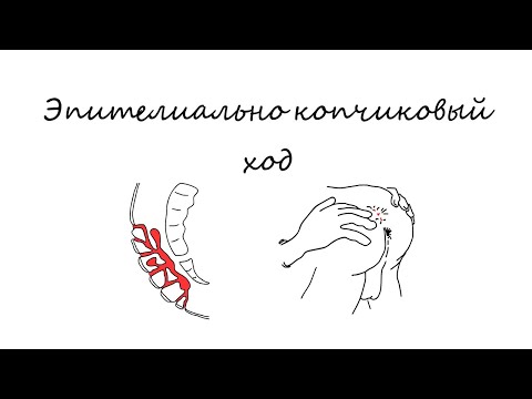 Видео: Эпителиально копчиковый ход I пилонидальная киста I ЭКХ