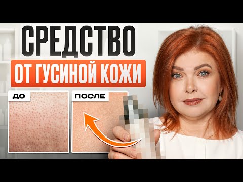 Видео: 3 РАБОЧИХ способа избавиться от ГУСИНОЙ КОЖИ НАВСЕГДА! Ты еще ЭТО не пробовала!