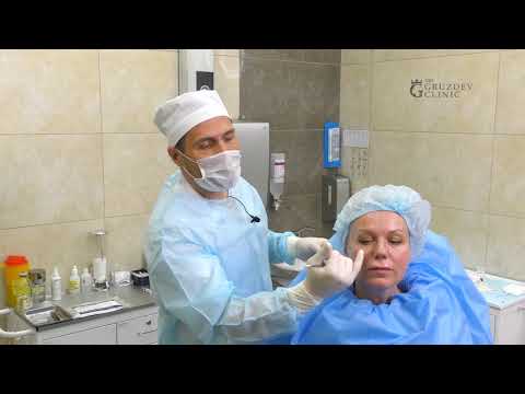 Видео: Нити для лица. Процедура нитевого лифтинга