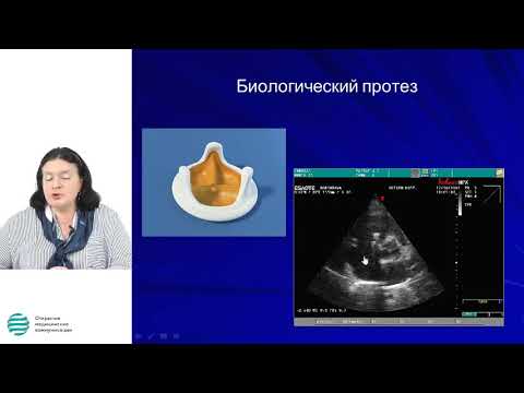 Видео: ЭхоКГ в оценке функции протезированных клапанов сердца и диагностике осложнений протезирования