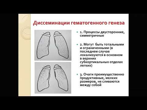 Видео: Фтизиатрия, диссеминированные формы