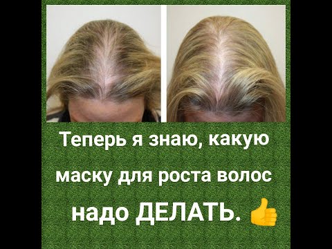 Видео: Супер маска для РОСТА ВОЛОС и против ВЫПАДЕНИЯ.