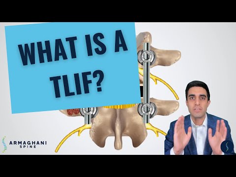 Видео: Как я провожу TLIF (и чего ожидать после)