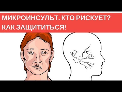 Видео: После микроинсульта. Что срочно начать делать?
