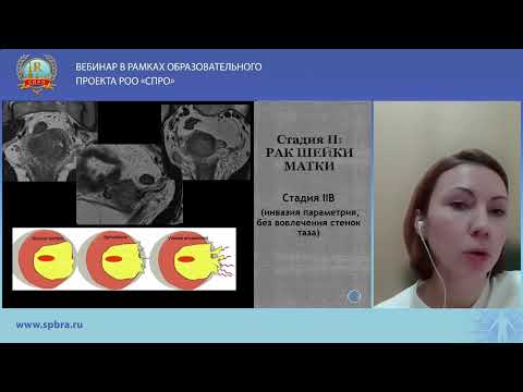 Видео: Cтадирование рака шейки матки c помощью МРТ. Обновленные рекомендации ESUR
