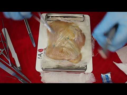 Видео: Пластика кожи встречными лоскутами (Хирургический шов)