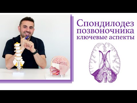 Видео: Спондилодез: ключевые аспекты метода сращивания позвонков