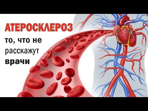 Видео: Бляшки в сосудах шеи. Будет инсульт?!