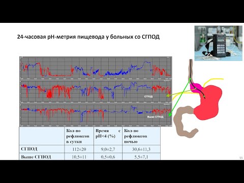 Видео: Пахомова И.Г., Солоницын Е.Г. ГЭРБ и ГПОД. Возможности врача амбулаторного звена