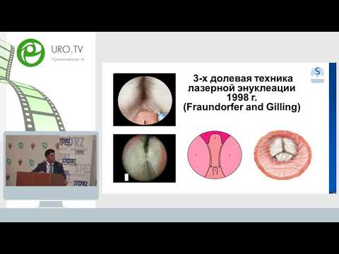 Видео: Сорокин Н И, Дымов А М - Основы эндоскопической энуклеации гиперплазии простаты