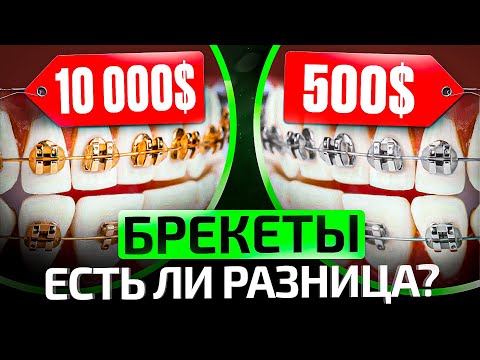 Видео: Самые дешевые и самые дорогие БРЕКЕТЫ — есть ли смысл переплачивать?