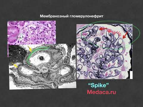 Видео: Мембранозный гломерулонефрит