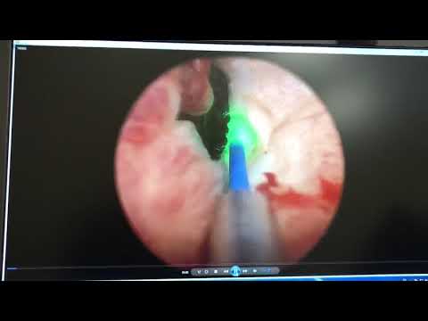 Видео: Уретроцистоскопия у пациента с опухолью мочевого пузыря!