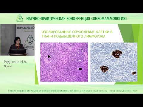 Видео: Редкие поражения лимфоузлов региональной клетчатки при раке молочной железы Трудности диагностики