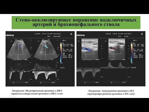 Видео: Павленко А.А. "Ультразвуковое исследование брахиоцефальных артерий" (Часть 2) 27.09.2023