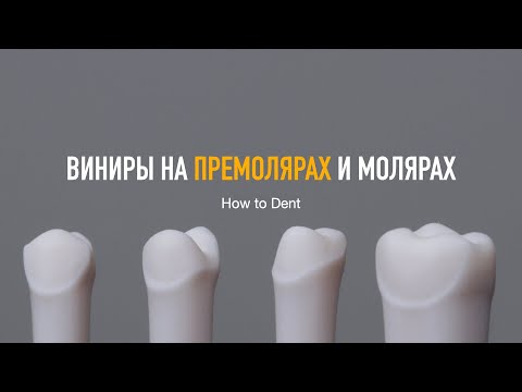 Видео: Виниры на премолярах и молярах. VeneerLay