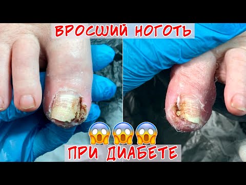 Видео: Вросший ноготь при сахарном диабете и онкологии / Хирург не помог 😖