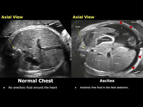 Видео: Акушерское УЗИ: норма или водянка плода | Перикардиальный, плевральный выпот, асцит и отёк кожи