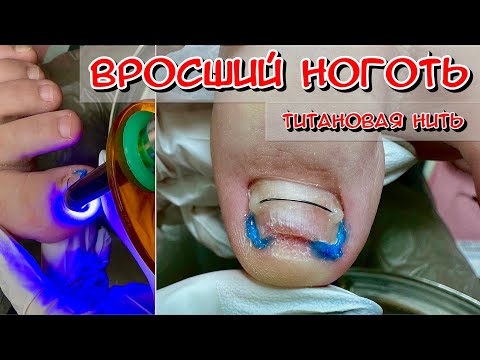 Видео: Вросший ноготь / Титановая нить / Скрученный ноготь / Вросший ноготь на ноге что делать