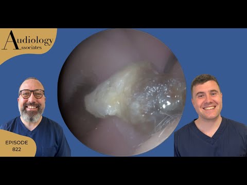 Видео: Удаление ушной серы - EP822