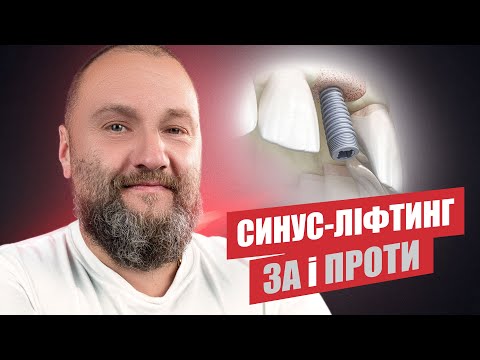 Видео: 🇺🇦 Синус-лифтинг, стоит ли делать?