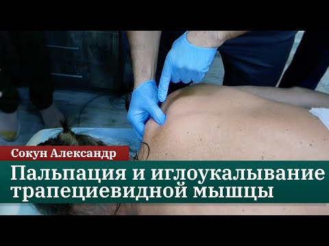 Видео: Техника пальпации и иглоукалывания трапециевидной мышцы. Сокун А.А.