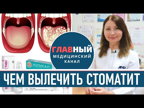 Видео: Лечение стоматита. Как и чем лечить стоматит у взрослых и детей в домашних условиях