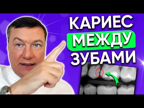 Видео: Как лечат кариес МЕЖДУ зубами? ЛЕЧЕНИЕ кариеса между зубами.