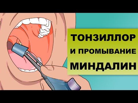 Видео: ПРОМЫВАНИЕ МИНДАЛИН ТОНЗИЛЛОРОМ: особенности процедуры