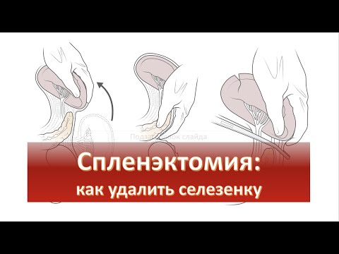 Видео: Спленэктомия: как удалить селезенку