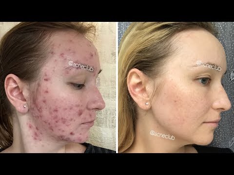 Видео: ДНЕВНИК ПОСТ-АКНЕКУТАНА: ПОЛГОДА СПУСТЯ