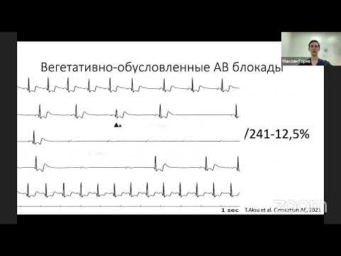 Видео: Когда можно обойтись без кардиостимулятора? Новая парадигма в лечении брадиаритмий