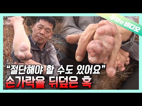 Видео: От пальцев рук до ног. Он покрыт опухолями, но то, что держит его сильным..