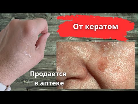 Видео: Легко и безопасно убрать кератомы без рубцов и шрамов