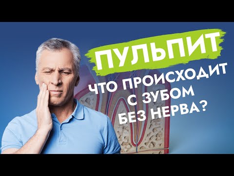 Видео: Пульпит. Что происходит с зубом без нерва?