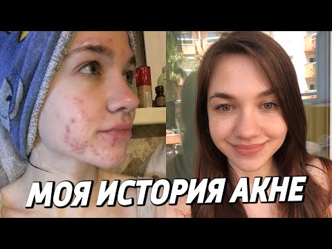 Видео: МОЯ ИСТОРИЯ АКНЕ | ПРЫЩИ