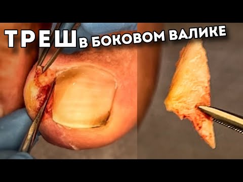 Видео: Острая фаза при вросшем ногте за 14 дней