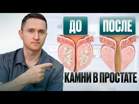 Видео: Как понять, что у тебя КАМНИ в простате?