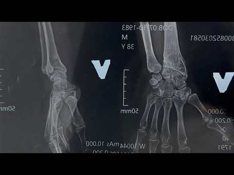 Видео: ПЕРЕЛОМ РУКИ 15 РОКІВ НАЗАД ⚕️😱