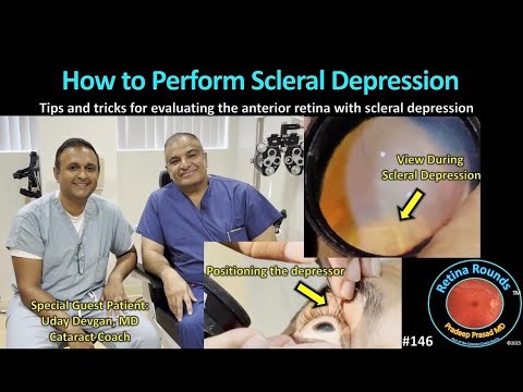 Видео: RetinaRounds™ 146: Как выполнить склеральную депрессию