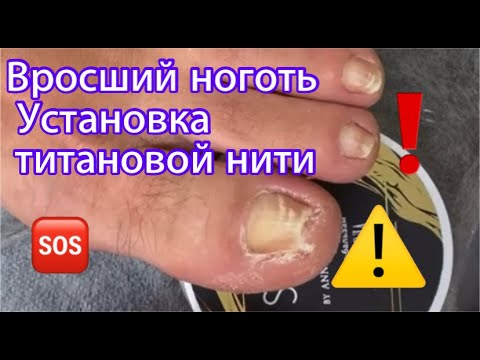 Видео: Вросшие ногти🦶🏻⚠️❗️ • Титановая нить💯👌