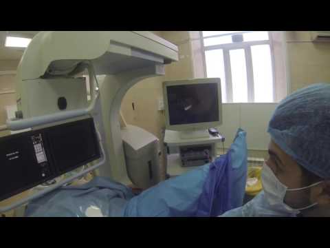 Видео: Вколоченный камень мочеточника, удаление камня в Москве