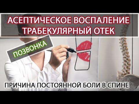 Видео: Ассептическое воспаление позвонка (трабекулярный отек). Вертебролог Игнатьев Радион Геннадиевич.