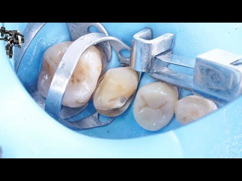 Видео: Восстановление премоляра | Глубокое поднятие края, матрица Гергиса и накладная накладка